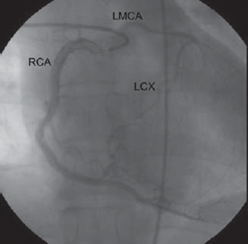 Figure 3. Selective right coronary angiogram reveals normal right coronary artery (RCA) with retrograde filling of the left circumflex artery (LCX) and up to ostium of the left main coronary artery (LMCA).