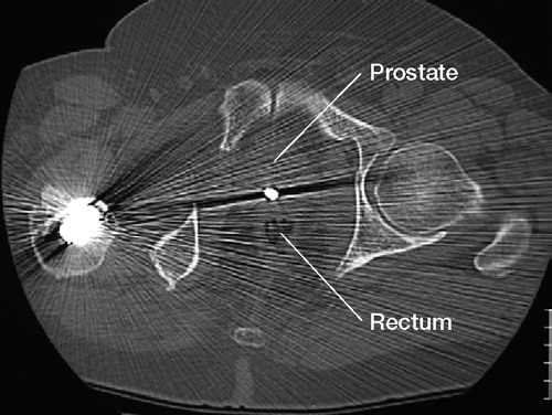 Figure 5. CT scan 10 months after surgery; transverse plane of the pelvis just below the level of the hip joint. Note the projection of the tip of the Steinmann pin crossing the narrow space between rectum and prostate, overlapped with mental artefacts of the pin.