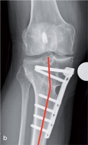 Figure 1. Example of extra-articular malalignment after high tibial osteotomy (HTO) with opening wedge technique. The red line on the left radiograph (a) indicates the mechanical axis lateral to the knee joint. The radiograph to the right (b) indicates the extra-articular angulation of the tibia in the osteotomy area.