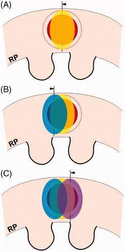 Figure 3. Over-ablation beyond the tumour margin during the RFA procedure. Arrowheads indicate RFA electrodes. (A) For radiofrequency ablation (RFA) of a spherical RCC (red), the shape of ablation zone (yellow) is not a circle but oval. Thus, the lateral areas of the RCC and tumour margin (dotted line) require additional ablations to prevent a residual or recurrent lesion. (B and C) Additional ablations (blue and violet) are performed to completely cover the tumour margin (dotted line) as well as the RCC (red). However, some over-ablation of normal tissue is created beyond the lateral tumour margin.