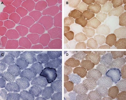 Figure 2. Abnormalities on skeletal muscle biopsy in mitochondrial myopathy. Serial sections through vastus lateralis in a patient with mitochondrial myopathy showing: (A) haematoxylin and eosin, (B) cytochrome c oxidase histochemistry (COX) (note the COX deficient fibres), (C) succinate dehydrogenase histochemistry (SDH) (note the sub-sarcolemmal accumulation of mitochondria analogous to a ragged red fibre), and (D) sequential COX-SDH histochemistry showing a mosaic COX defect as seen in patients with mtDNA disorders.