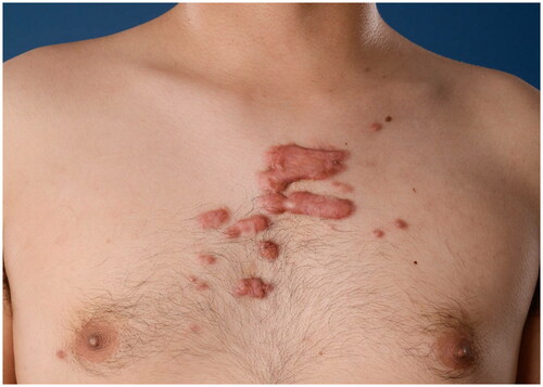 Figure 2. Multiple keloids on the chest.