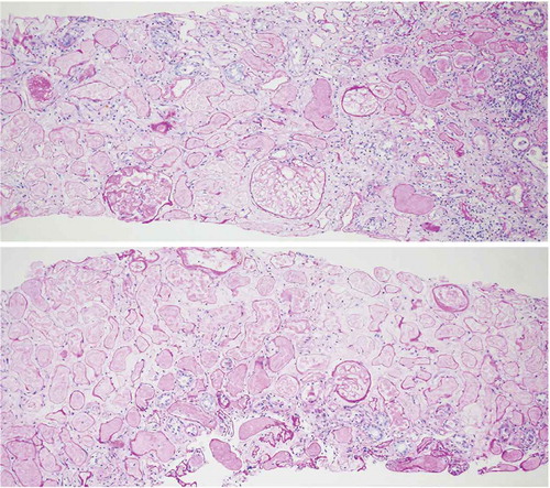 Figure 1. Kidney biopsy: complete necrosis of the renal cortex and medulla as well as fibrin thrombi in some glomeruli,periodic acid-schiff (PAS), ×100.