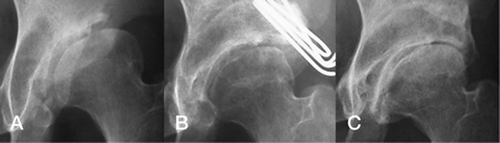 Figure 5. A. 34-year-old woman with early-stage osteo-arthritis preoperatively. The hip score was 10 points and the roundness index was 68%. B. 3 months postoperatively. C. 11 years postoperatively: narrowed joint space on the lateral side; late advanced stage coxarthrosis. The hip score was 15 points.