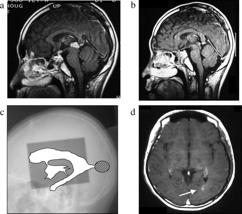 Figure 1.  Case 1, a 12-year-old boy. a: Pre-treatment MRI scan revealing a pineal mass. b: Post-treatment MRI scan revealing disappearance of the pineal mass. c: On this x-radiograph, the field of irradiation (gray area) and ventricles (white area) on MRI scans are traced. The relapse site is identified by a hatched circle. d: This post-treatment MRI scan shows an enhanced lesion in the posterior horn of the left lateral ventricle (arrow).