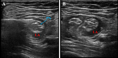 Figure 1 Ultrasound-guided popliteal nerve block. (A) Proximal popliteal nerve with “onion-bulb” appearance, with needle placement and local anesthetic deposition. (B) Distal spread of local anesthetic, post-bifurcation of popliteal nerve.