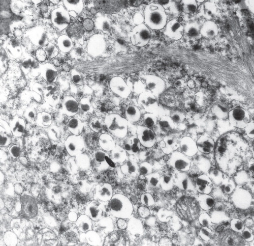 Figure 6. Electron micrograph showing a part of a β-cell from a diabetic subject. There are bundles of typical amyloid fibrils which penetrate deeply into the cells. Note that the cell is filled with characteristic insulin granules.
