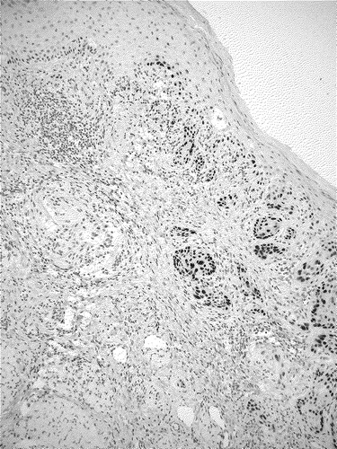 Figure 2.  Invasive moderate differentiated squamous cell carcinoma of the conjunctiva. Immunohistochemically a clear strong overexpression of p53 is seen only in the nuclei of the carcinoma (lower right), which contrasts to the p53-negative epithelium in the vicinity (upper left). Anti-p53, avidin biotin complex method.