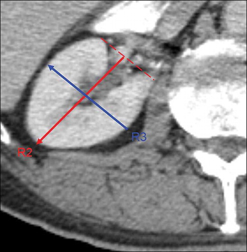 Figure 2. Axial computed tomography (CT) image obtained via pan zooming to kidney; distance up to lateral margin from the level of renal hilus (R2) and bicortical length perpendicular to R2 (R3).