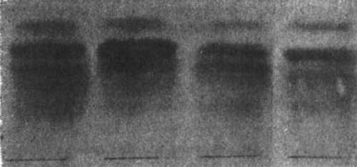 Figure 3.  Polysaccharide pattern after electrophoresis in a buffer of pH 4.5. The upper fraction is M1 i.e. mainly orosomucoid. Nr. 1. Abnormal. Normal. No. 5.