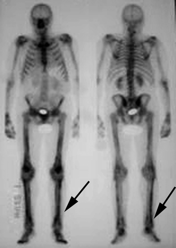 Figure 1.  Isotope bone scan showing increased uptake in the tibia and fibula bilaterally.