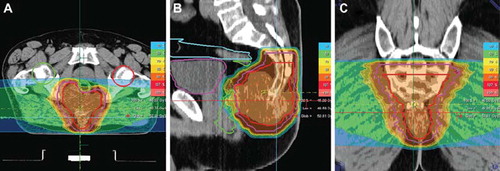 Figure 2. Carbon ion radiotherapy for histologicall confimred sacral chordoma treated with two horizontal beams up to a total dose of 60 Gy E in single fractions of 3 Gy E.