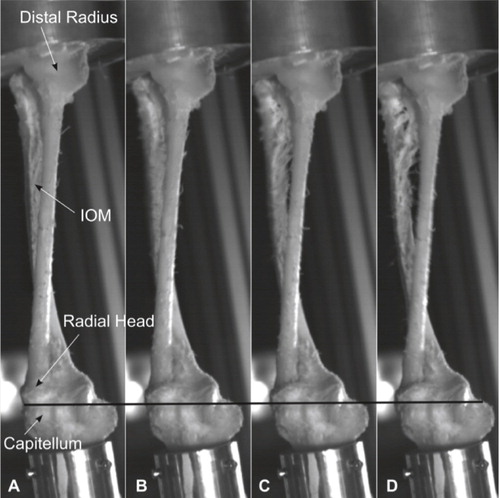 Figure 3. Part 1 of the sequence of development of an Essex-Lopresti lesion. A. Unloaded specimen. B. Loading leads to slight impaction and bending of radius and ulna, and thereby to a transverse movement of the radial and ulnar shaft away from each other (see increasing distance between radial and ulnar shaft), leading to tension of the interosseous membrane (IOM). C. Due to the rising tension in the IOM, the IOM ruptures and ulna and radius separate further. D. A slight proximalization of the radius—and thereby of the radial head—is detectable (see movement of radial head in relation to the black line).
