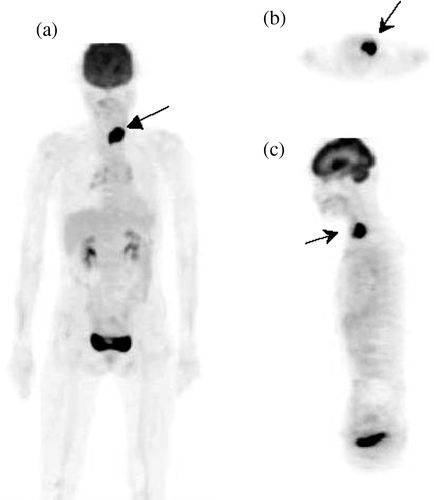 Figure 2.  Whole-body PET performed 45 min after an intravenous injection of 370 MBq FDG using a Siemens ACCEL PET scanner. (A) Maximal intensity projection (MIP) view, (B) transverse section, and (C) sagittal section revealing focally intense FDG uptake in the anterior left side of the neck. The maximal standard uptake value (SUVm) of the lesion was 12.2. No abnormal uptake was demonstrated on the right side of the neck or elsewhere.