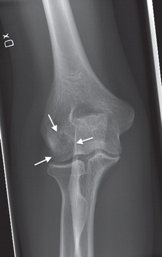 Figure 2. Standard anteroposterior radiography of the elbow 4 months postoperatively verifying consolidation of the osteonecrotic lesion.