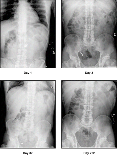Fig. 1.  Abdominal radiographs show the progression of mercury from the stomach pylorus (Day 1) to the appendix (Days 3 and 37) to its eventual evacuation (Day 222).