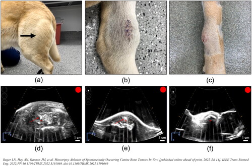 Figure 5. Representative photographs of grossly visible OS tumors and US bubble cloud photos during treatment. (a–c) Patient images showing different gross appearances between the treated primary bone tumors correlating to different radiographic tumor characteristics representing (a) a grossly visible extensive soft tissue component (arrow), (b) a primarily lytic tumor with a small amount of soft tissue component, and (c) a primarily proliferative bone tumor with mostly intact cortical bone. (d–f) B-mode ultrasound images during treatment. Cavitation bubble clouds (arrows) were visible when histotripsy was applied to the soft tissue tumor component and lytic tumors (d,e), but not when applied to patients with proliferative bone tumors and mostly intact cortical bone (f).
