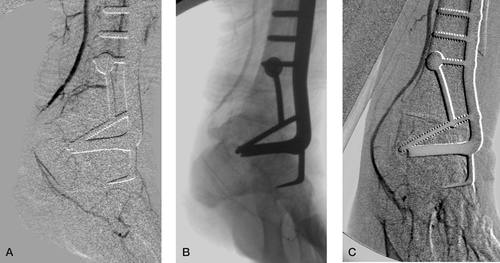 Figure 2. A. Digital subtraction angiography (DSA), showing occlusion of the posterior tibial artery. B. The native angiogram showing that the occlusion was due to external compression by the posterior talar process. C. Control angiography showing a patent posterior tibial artery, after removal of the posterior talar process.