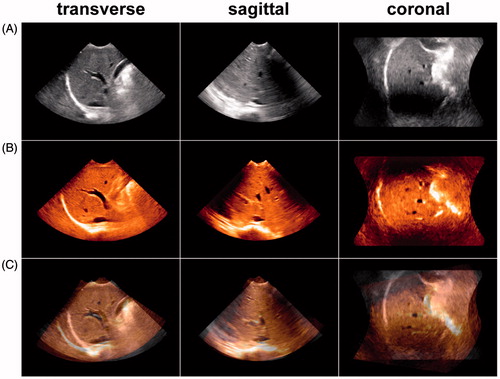Figure 6. (A) Reference image of the anterior right liver lobe in the transverse, sagittal and coronal planes acquired at end inspiration. (B) Floating image of the anterior right liver lobe acquired at end expiration with the same acquisition conditions as in A. (C) Fusion image of A and B; the vessel trees of A and B did not overlap, and the registration error distance was 14.67 mm. This result indicated that the image fusion of the 3D VT-based automatic registration was a failure.