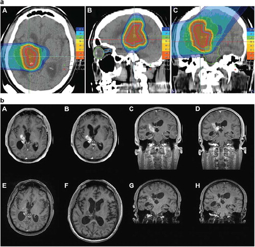 Figure 1. a, Carbon ion radiotherapy for recurrent glioblastoma using two horizontal beams. Treatment was performed up to a total dose fo 36 Gy E in 12 fractions ((A) axial, (B) sagittal and (C) coronal view). b, A–D – contrast-enhanced T1-weighted MR-imaging performed for treatment planning prior to carbon ion radiotherapy. E–H – neuroimaging performed 6 weeks after completion of carbon ion radiotherapy with 36 Gy E.