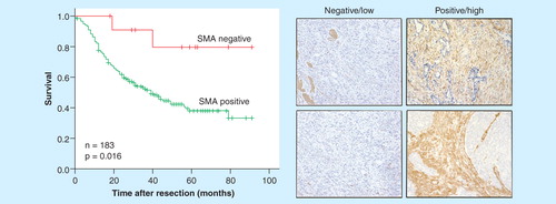 Figure 2. CAF in the tumor microenvironment predict survival in EAC. Left panel – Kaplan-Meier survival curve following esophagectomy in α-SMA positive and negative tumors. Median survival α-SMA positive tumors = 39 months. Hazard ratio: 7.1 (1.7–29.4; p = 0.007). More predictive than T, N, M or R status. Right panel – representative immunohistochemistry.