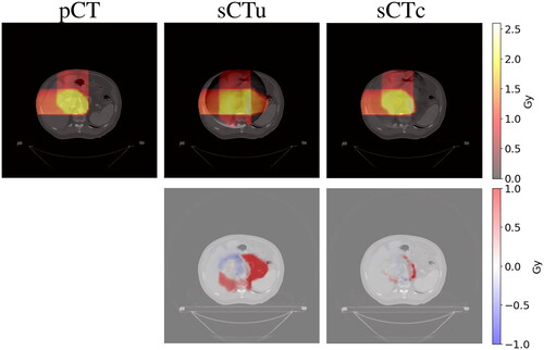 Figure 10. Example of dose planning for an axial slice of a subject for the original pCT, sCTu, and sCTc (upper row). The difference between both sCT treatment plans with respect to the original pCT plan is shown in the bottom row. Synthetic CT scans in this figure were produced using a real CBCT as the input.