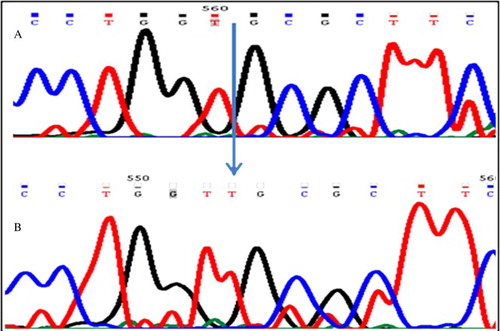 Figure 4. Sequence electrophoreogram of the SNP variant. The insertion c. Ins T 396-397 3′UTR TNP1 gene is highlighted. A) represents sequence showing homozygous wild-type (GGTG); B) represents sequence showing insertion (GGTTG).