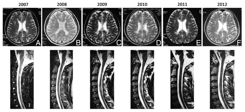 Figure 1. Axial (A–E) fluid attenuation inversion recovery (FLAIR) MRI Brain and sagittal T2-weighted MRI of the cervical cord (1–5) demonstrate a stable distribution of lesions from 2007 (A and 1) to 2012 (F and 6).