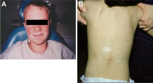 Figure 3 Examples of tuberous sclerosis complex-associated skin lesions: (A) angiofibromas and (B) shagreen patches and ash leaf macules.