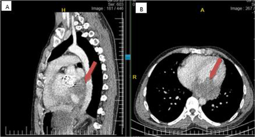 Figure 4 Chest CT -Sagittal (A) and Axial (B) both showing left ventricle showing aneurysmic dilatation and thrombus formation (red arrow).