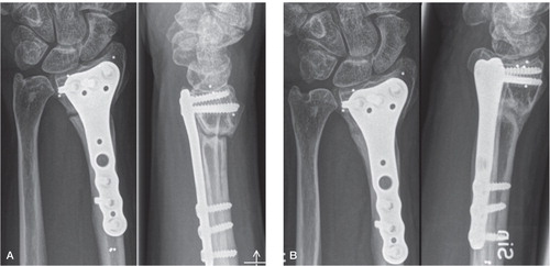 Figure 2. Non-union in case 13. A. 5 months postoperatively, with sclerosis of the cut surfaces. B. 3 months after revision, with non-structural iliac crest bone graft.