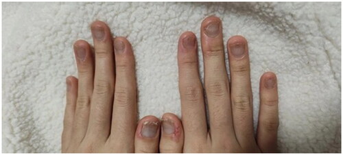 Figure 5. Week 20 resolution of nails psoriasis.