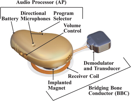 Figure 1. 3D model of the audio processor (including digital signal processor, modulator, transmitter coil and retention magnet (not shown), directional microphones, battery, program selector, and volume control), and the bridging bone conductor (including receiver coil, internal retention magnet, demodulator, and transducer).
