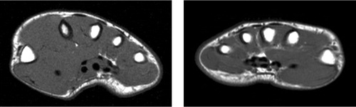 Figure 3. MRI of the right and left hands (T1-weighted images) showing hypertrophied (but otherwise normal-looking) first dorsal interosseous and thenar muscles in the right hand.