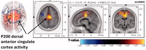 Figure 4. Cortical source current density difference map depicting greater dorsal anterior cingulate P200 activation during rejection than neutral scenes.
