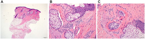 Figure 2. Histopathological examination from lesional scalp biopsy in (A) low power view of skin punch biopsy, examined vertically, showing mild follicular plugging and perifollicular fibrosis. There appears to be reduction in the hair density, with mild inflammation confined to the upper parts of the hair follicle. Some dilated eccrine ducts are also noted in the lower dermis (hematoxylin-eosin, original magnification ×4). (B) Mild perifollicular chronic inflammation with foci of interface inflammation (hematoxylin-eosin, original magnification ×20). (C) Focal area of perifollicular fibrosis (hematoxylin-eosin, original magnification ×20).
