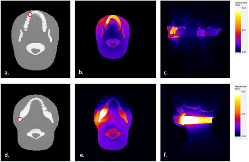 Figure 1. Monte Carlo (ImpactMC) simulation of the 3D radiation dose distribution for CBCT scans of impacted maxillary canines and mandibular third molars with 40Ø × 35 mm FOV as applied to ATOM anthropomorphic female adult head and neck phantom model. (a) Imaging field positioning according to the location of a left maxillary canine tooth. (b) Simulated radiation dose distribution in axial view and (c) sagittal view for impacted maxillary canine, presented as a relative color heatmap. (d) Imaging field positioning according to the location of a left mandibular third molar tooth. (e) Simulated radiation dose distribution in axial view and (f) sagittal view for impacted mandibular third molar, presented as a relative color heatmap.