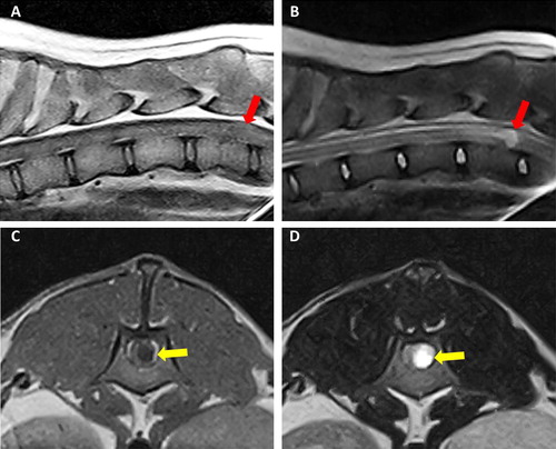 Figure 1. Case 1: sagittal T1-W (A) and T2-W (B) images of thoraco-lumbar spinal cord showing a roundish, well-demarcated lesion at the level of the 13th thoracic vertebra (red arrows). The lesion was iso- to slightly hypointense on T1-W images (A) and hyperintense on T2-W. Case 2: T1-W (C) and T2-W transverse (D) views of the apparently intradural-intramedullary cyst located at the level of L1 (yellow arrows). The content of the cyst appeared hyperintense in T2-W and hypointense on T1-W images.