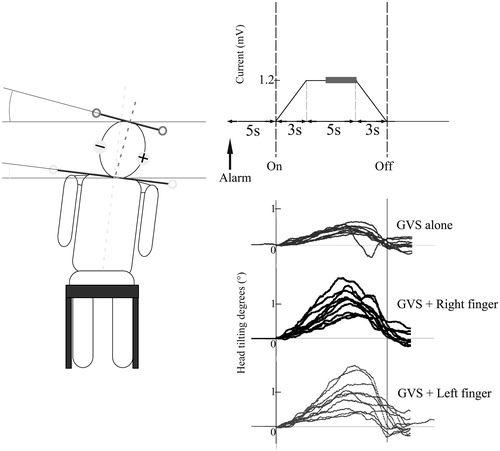 Figure 2. Schematic of the experimental design. Left panel displays a tilting response to the anodal direction in the sitting position. Participants were instructed to adjust their posture to their subjective vertical on their own accord with a notice alarm. After the notice alarm, 1.2 mA of direct current (trapezoidal pulse) was delivered to the mastoid processes via a right anode and a left cathode (right top panel). The displacement of the mean head positions during the last 3 seconds of the 5-second constant current period (grey bold line) from the time of GVS onset in each trial was analysed. Raw data from a representative healthy participant are shown (right bottom panel). Each condition consisted of 10 trials (lines) and lines show head tilting responses to the anodal direction during GVS.