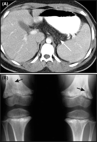 Figure 5. Phenotypic features of Shwachman–Diamond syndrome (SDS). (A) MRI showing fatty infiltration of the pancreas (white arrow). (B) Metaphyseal dysostosis (black arrows). Images courtesy of William H. McAlister, MD.