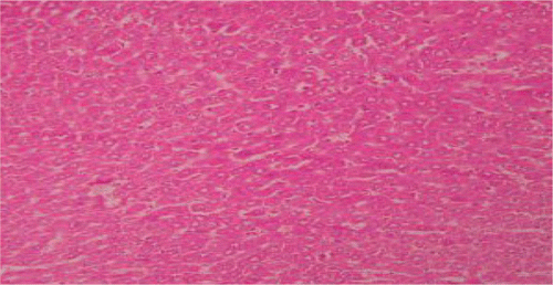 Figure 5.  Liver section of PdEE (200 mg/kg) and paracetamol showing moderate fatty changes, necrosis, ballooning degeneration and no infiltration of lymphocytes.