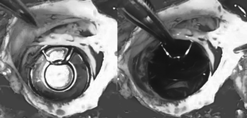 Figure 1. The Björk-Shiley tilting disk aortic prosthesis is inspected through the dissected aortic root 37 years after implantation. The valve is tightly adhered to the aortic annulus with no evidence of perivalvular leak. The tilting disk and the holding mechanism show no structural deformity or sign of fatigue despite opening for more than 1,3 billion cycles.