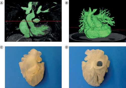 Figure 1. 3D printing in cardiothoracic surgery. (A) Segmentation of anatomic structure/region of interest. (B) Creation of stereolithography file and computer-aided design model. (C & D) Three-dimensional model created by 3D printer.Reproduced with permission from [Citation32] © SAGE publications (2014).