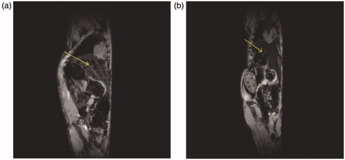 Figure 1. An MRI (gradient echo, TR/TE = 100/4 ms, flip angle 30°, FOV = 5.5 × 2.5 cm, 256 × 256) of a mouse liver obtained at 9.4 T (A) before and (B) after injection of iron oxide (Nano-Ocean, Springdale, AR). The decrease of MR signal within the liver (yellow arrow) is visible (Blasiak et al. Citation2013).