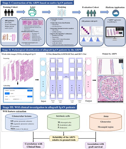 Figure 1. Workflow of our study. At stage I, the analytic renal pathology system (ARPS) was established. A dataset consisting of 41,000 patches obtained from 400 native immunoglobulin A nephropathy (IgAN) patients was utilized, with the patches carefully labeled for the location and identification of glomeruli lesions (GS, SS, C and NOA). Moreover, for the identification of intrinsic glomerular cells, we selected and labeled 460 images of glomeruli (about 70 000 cells, including M, E and P) from NOA samples. The ARPS system exhibited exceptional performance in accurately categorizing glomerular lesion types and intrinsic glomerular cells (Citation13). Stage II is allograft tissue compartment recognition, where periodic acid-Schiff (PAS) slides of allograft IgAN patients were scanned and then uploaded. After that, the ARPS identified the glomerular lesions and internal glomerular structures using U-Net, DenseNet, LSTM-GCNet and 2D V-Net. Stage III is the whole-slide image (WSI) clinical investigation, where we evaluated the reliability of the ARPS relative to ground truth (evaluated by a pathologist) in identifying glomerular lesions and internal glomerular structures. Meanwhile, the glomerular area, mesangial area, glomerular lesions (SS, GS, C and NOA) and intrinsic glomerular cells (M, E and P) automatically identified by the ARPS were further examined through association with clinical data and post-transplantation graft survival.