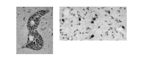 Figure 1 Two patterns of tumor growth in the brain. Tumor often grows around blood vessels (left), but some tumors can also infiltrate the brain parenchyma (right).