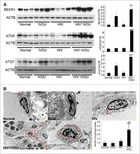 Figure 9. Significant increase in the expression of autophagy related proteins and number of autophagosomes or autolysosomes in the human lungs from HIV-infected IVDUs. (A) Western blot analysis of total lung extracts from normal, HIV-infected and /or IVDUs for BECN1, ATG5 and ATG7 expression. Graphs represent the densitometry analysis of the blots. (B) TEM analysis showing autophagic bodies (autophagosomes or autolysosomes) in the endothelial lining of the pulmonary blood vessels (3000X magnification). Lower panel shows the 800X magnification image with an area (red box) of the blood vessel from where representative 3000X image of HIV+ IVDU group was captured. The graph represents the average number of autophagic bodies counted in at least 24 cells per group (n = 2 per group). *P < 0.05, **P < 0.01 vs. normal, #P < 0.05 vs. IVDU, $P < 0.05 vs HIV. Scale bars: 500 nm.