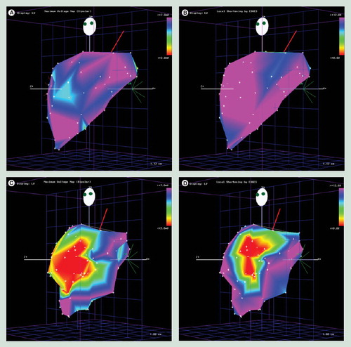 Figure 1. Electromechanical maps of the left ventrical.(A) Unipolar voltage map and (B) linear local shortening map of a normal dog left ventricle. (C) After experimental left anterior descending artery occlusion, unipolar voltage map and (D) linear local shortening map were performed on the same animal.Images courtesy of Biologics Delivery Systems Group Inc.