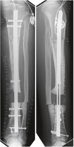 Figure 2. Immediately postoperatively, showing tibial bone gap after bone resection. The bone transport and lengthening nail is inserted in the tibia after proximal tibial osteotomy and distal fibula osteotomy.
