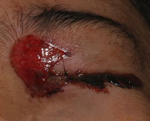 Figure 1 Severe eye trauma with eyelid laceration and open globe injury in a child with firework injury.